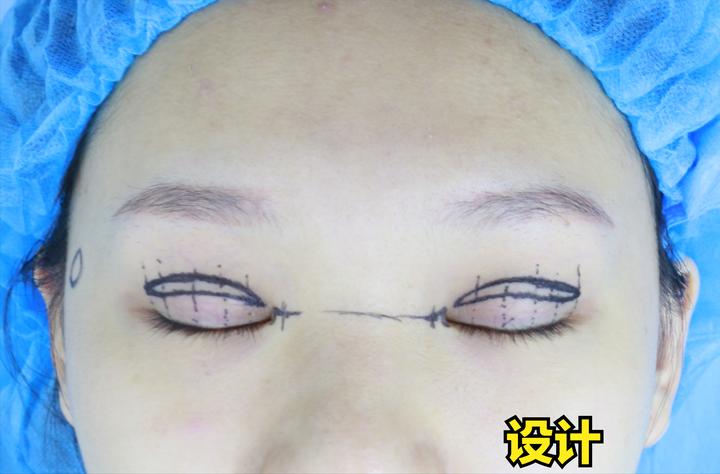 修复假宽深双眼皮最好的医院,双眼皮做宽了显老怎么补救