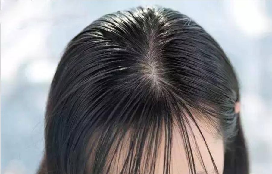 头皮屑太多怎么办导致身体很痒,头皮屑太多怎么办简单处理小妙招