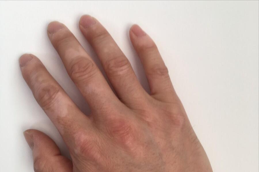 白癜风不去控制多久扩散,白癜风不及时医治的危害