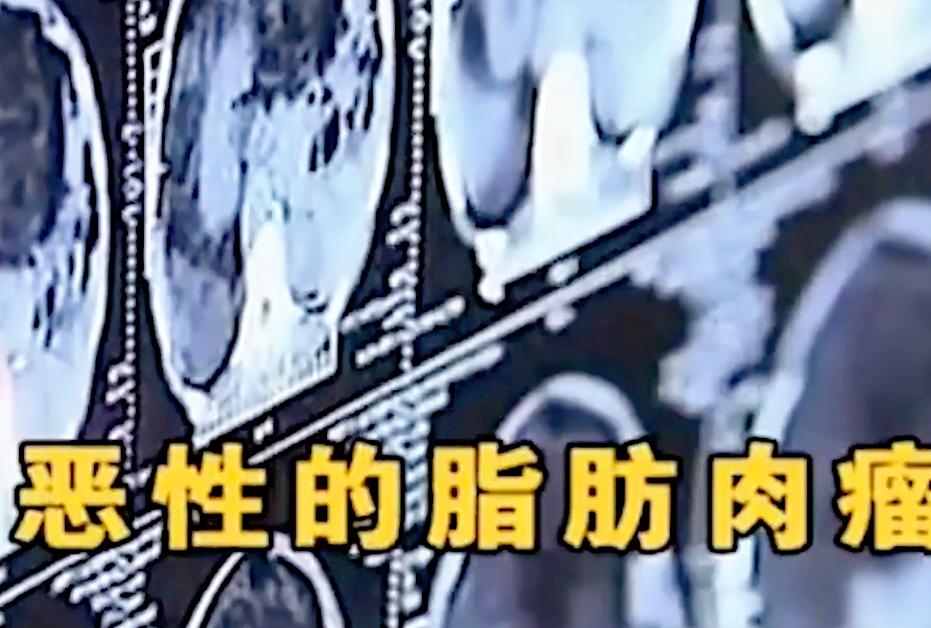 50岁大爷查不出五脏六腑,50岁大爷去体检找不到器官