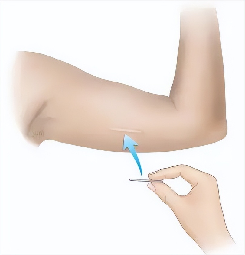 男性避孕结扎可以恢复生育能力吗,男性结扎是最好的避孕措施