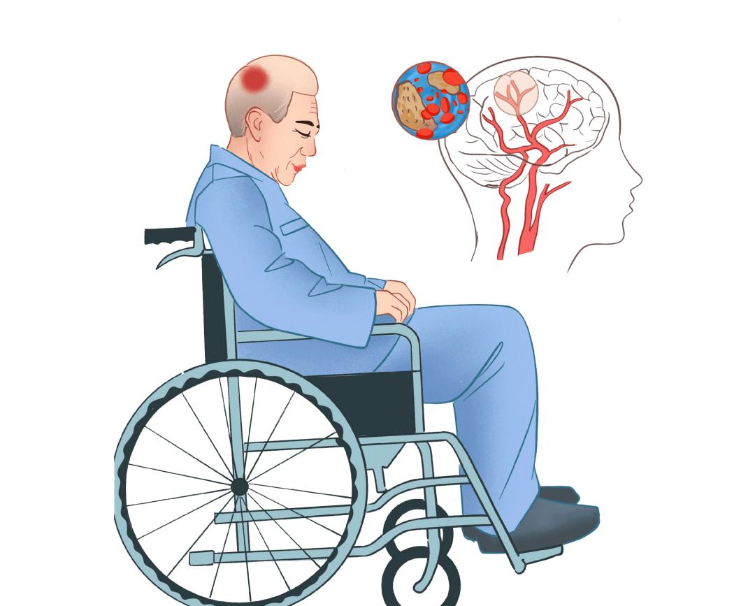 中医无痛治疗?芒针治疗中风后的寒热错杂型消化不良疗效相关研究
