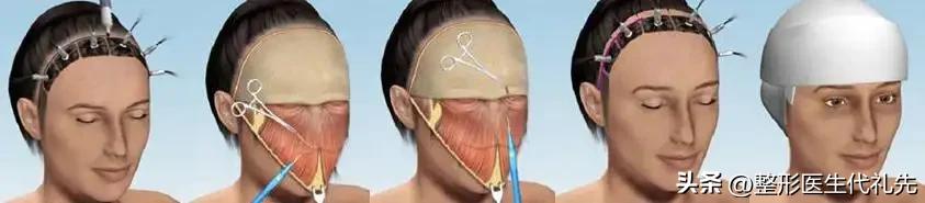 拉皮手术和面部提升术有什么区别,小拉皮和额头提升术的区别
