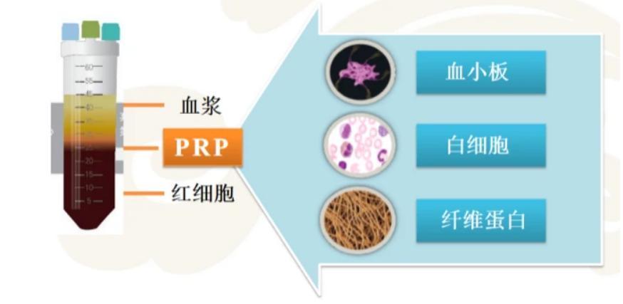 关节prp治疗要打麻药吗,风湿性关节炎prp