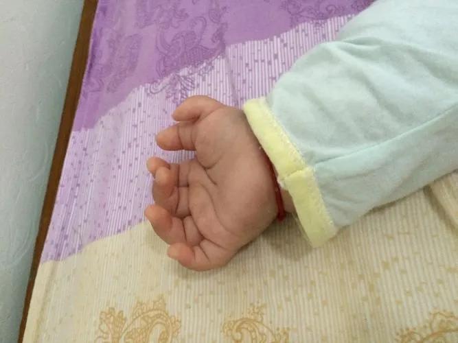 骈拇一：无论出生时脚趾长在一起，还是天生六指，都是多长了东西