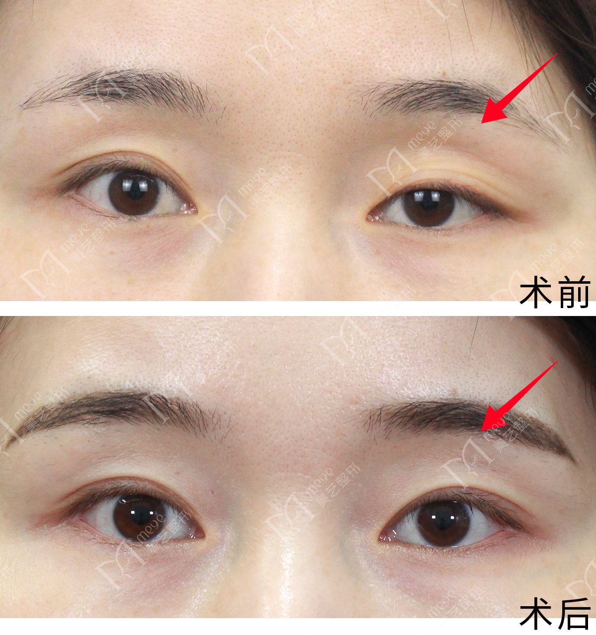 眼睛一大一小的解决方法,眼睛一大一小严重怎么办