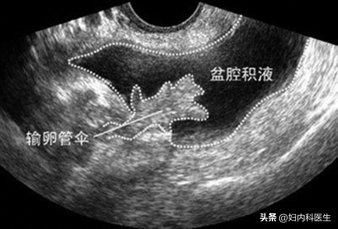 检查出有盆腔积液怎么办,如果查出有盆腔积液怎么治疗