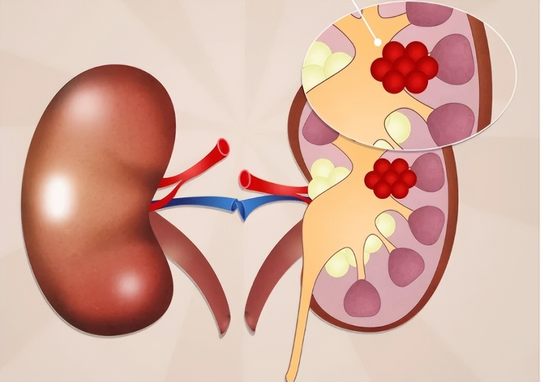 肾癌最好的手术方式,肾癌术后减轻的体重会恢复吗