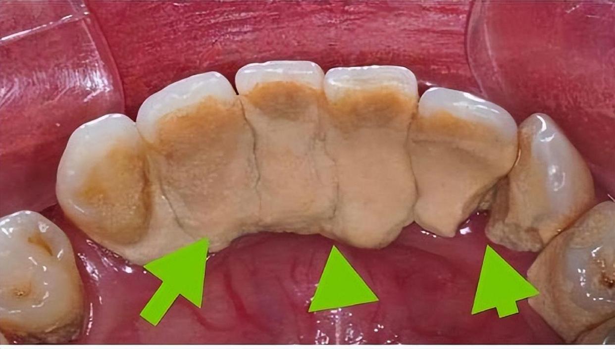 牙齿里小石头,牙齿上的小石头用什么可以去除