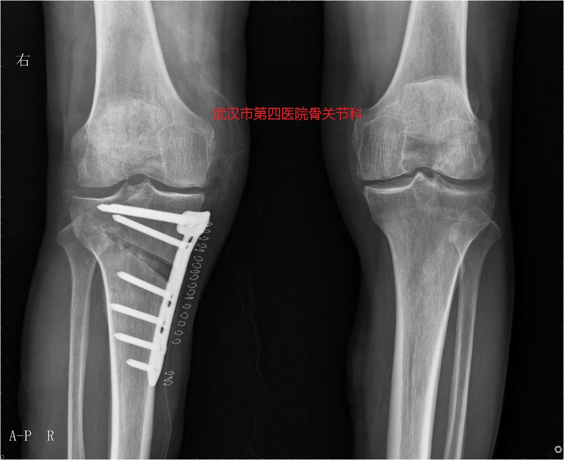 膝关节炎阶梯治疗专家共识,了解膝关节炎的预防和治疗很关键