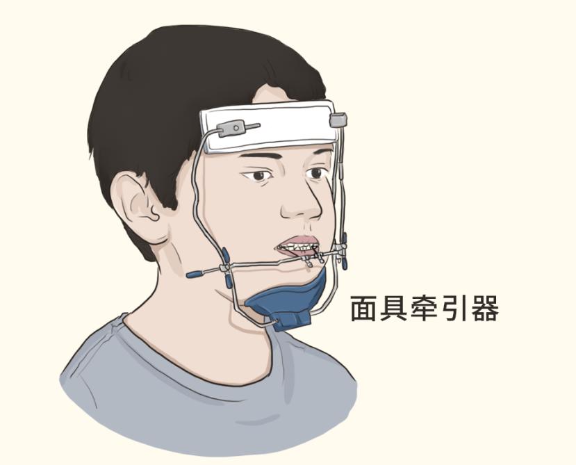 下巴后缩和下巴短怎么区分,下巴短小的原因