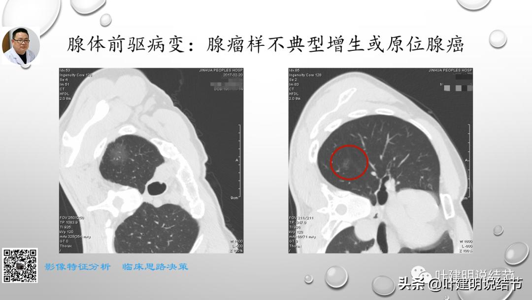 在《一脉阳光》呼吸影像诊断专题培训班上的讲课PPT（第一部分）