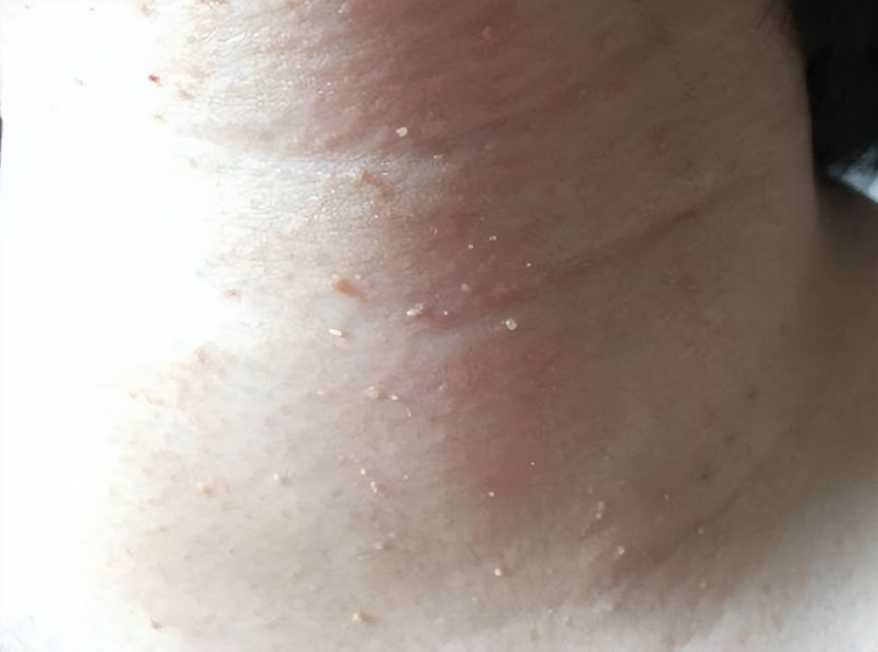 脖子上肉粒可以自己揪掉么,脖子腋下长小肉粒可以用手揪掉吗