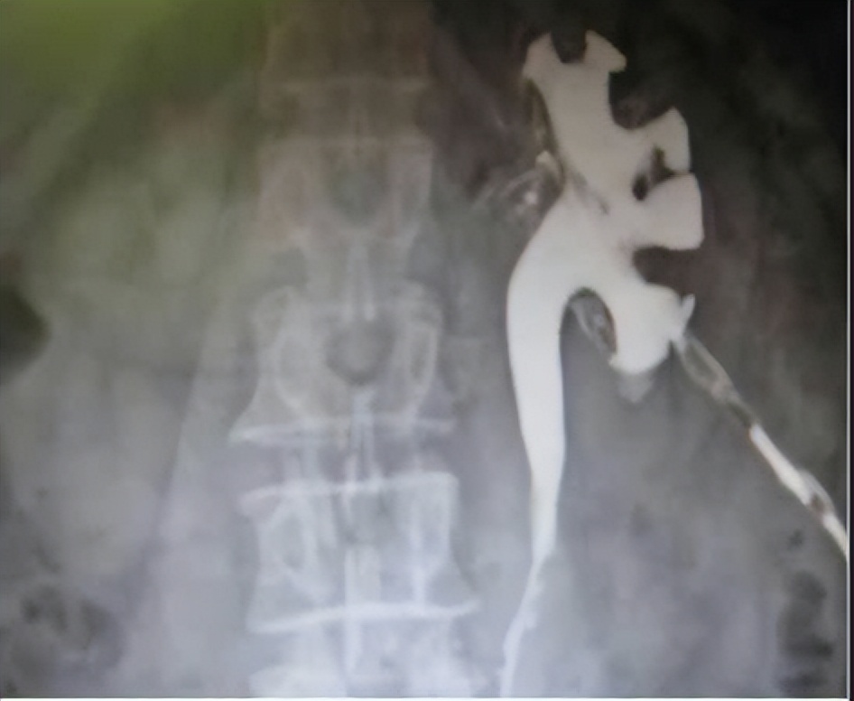 乳糜尿的病因、诊断与治疗