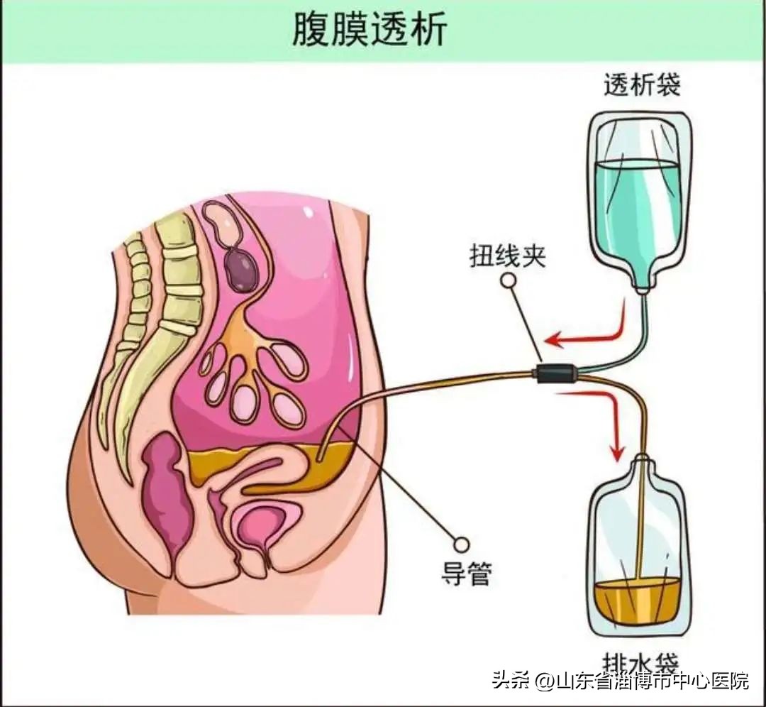 市中心医院腹膜透析,中心医院血透室电话
