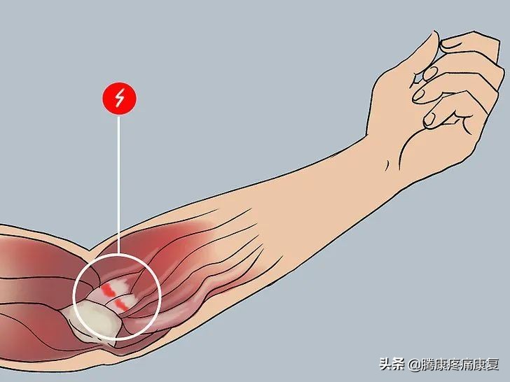 前臂疼痛，这五个动作就能缓解