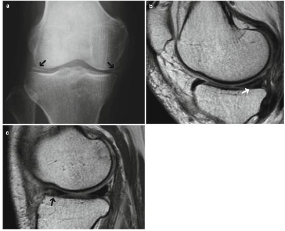 半月板钙化的影像表现,磁共振显示半月板撕裂的可能