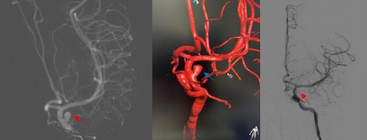 左侧大脑中动脉重度狭窄手术过程,颅内动脉重度狭窄能做手术吗