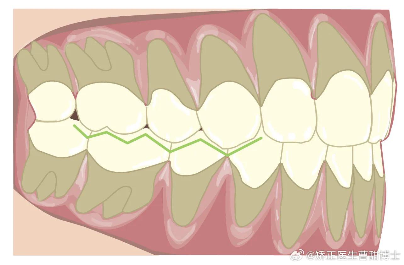 牙齿矫正咬合不对位正常吗,矫正牙齿后面咬合不好怎么办