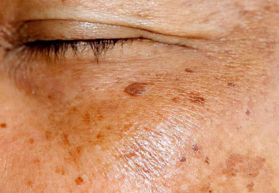 老年斑红霉素可以去除吗,老年斑红霉素