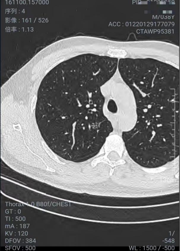 磨玻璃结节9*8mm建议随访,8mm磨玻璃结节一年没长