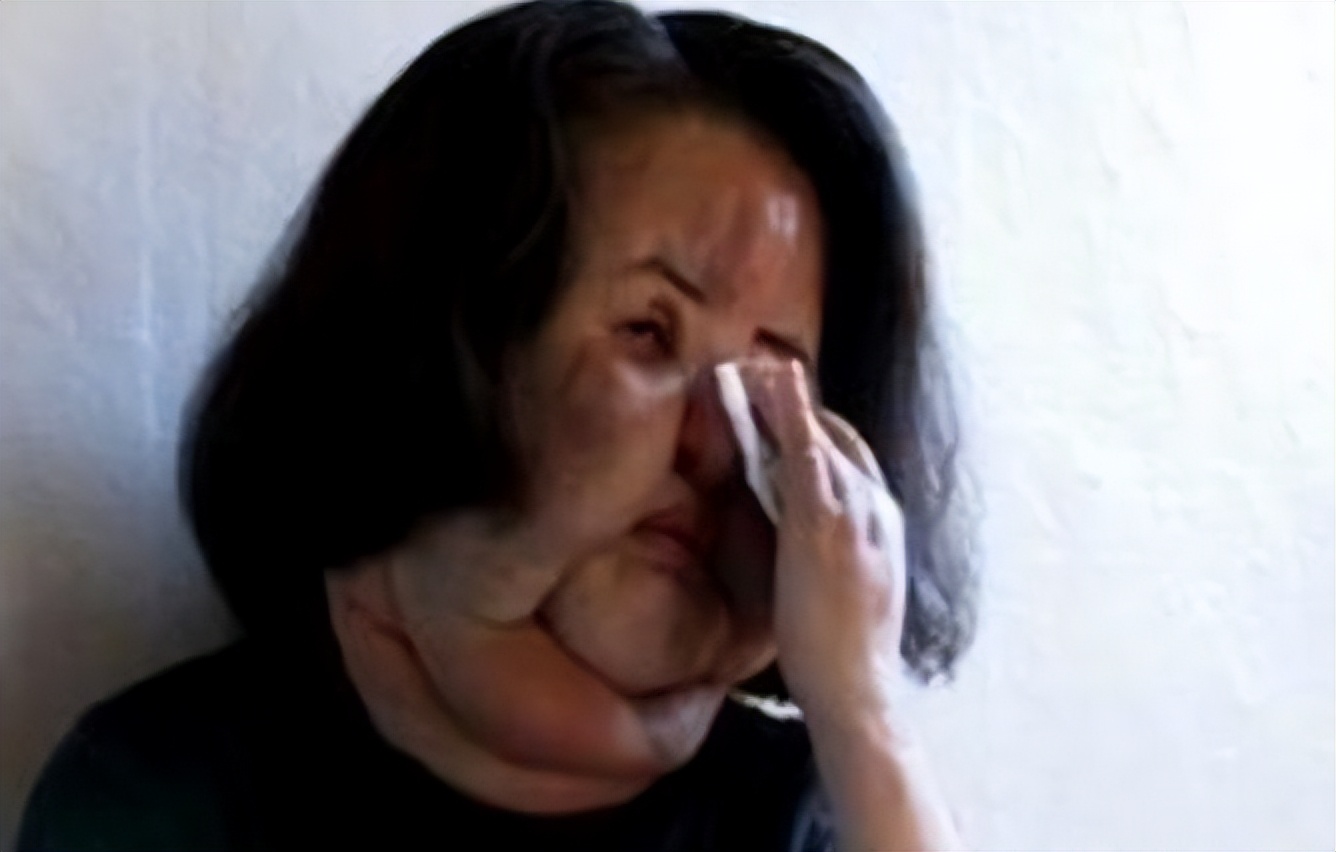 韩慧景整容是打了玻尿酸了吗,韩慧景整容案例