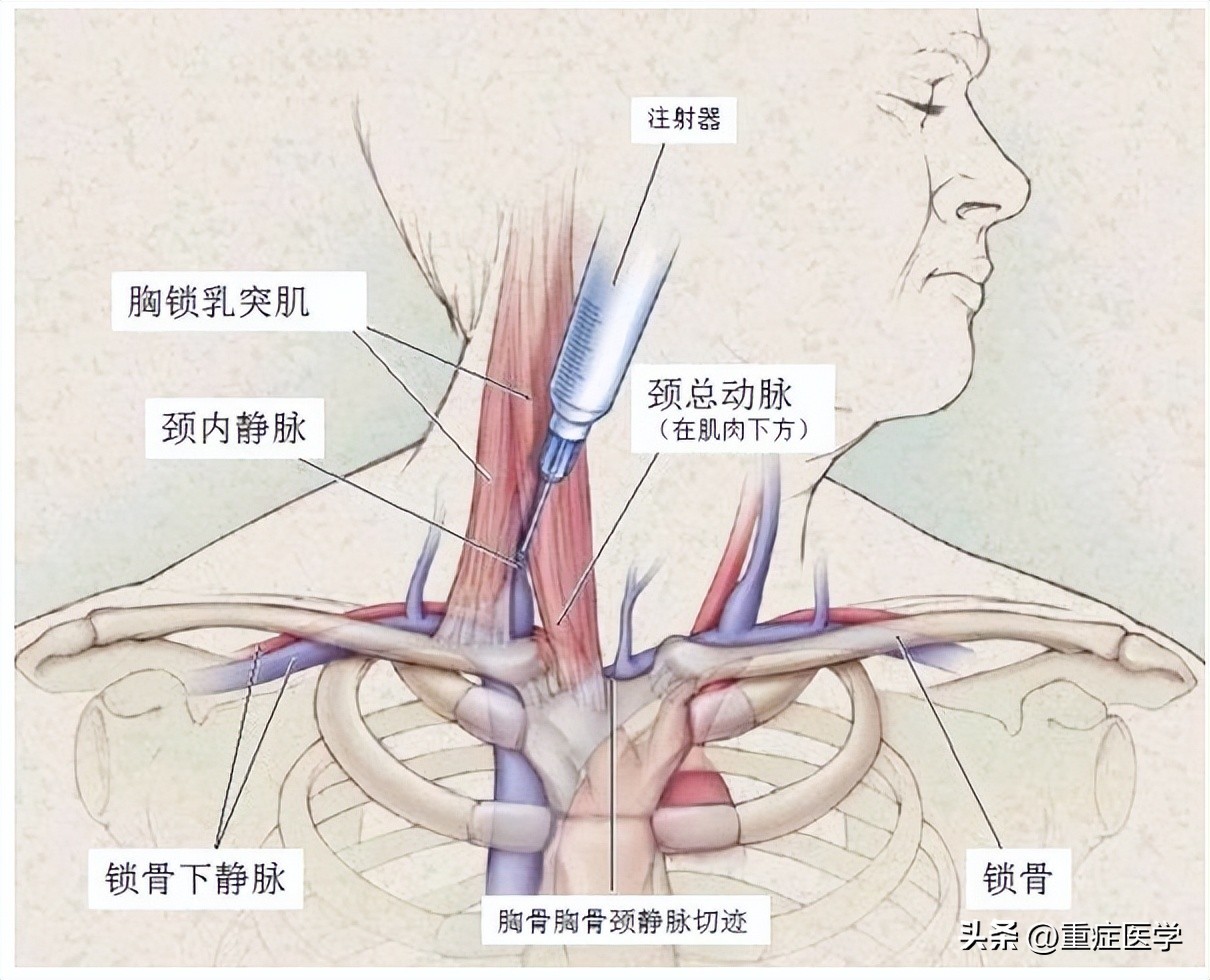 保姆级深静脉穿刺全攻略，建议收藏！