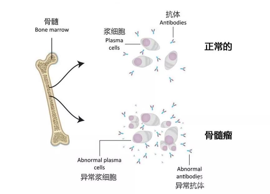 老年人血癌的治疗福音，这2款靶向药物纳入医保
