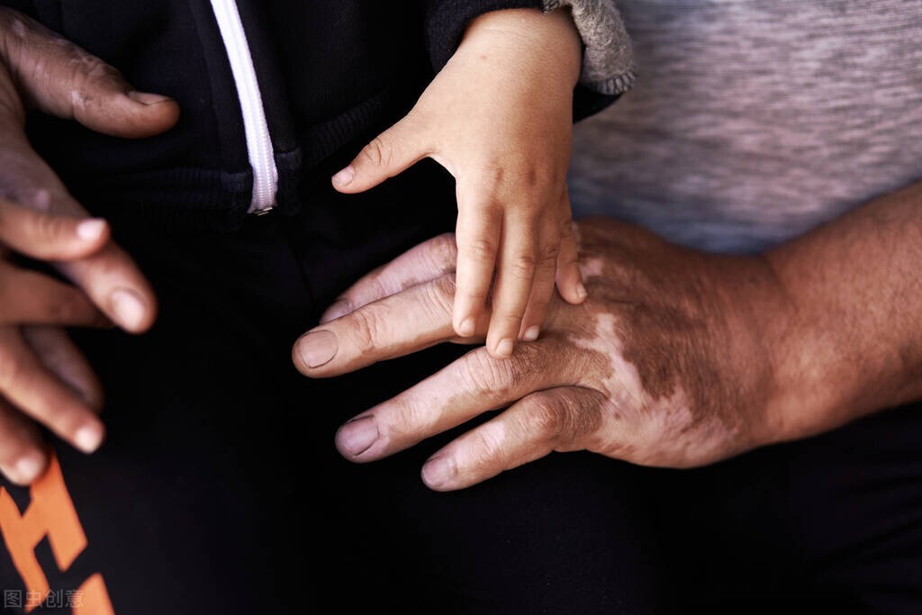 外伤性白癜风好发部位有哪些,外伤性白癜风十几年不扩散