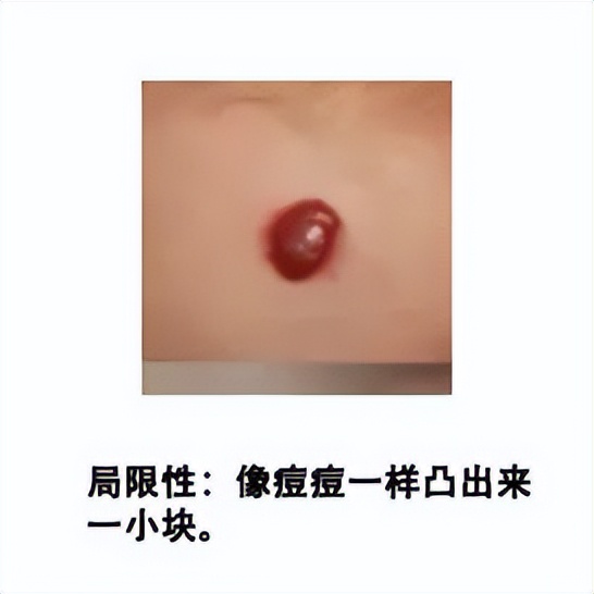 小孩胎记长肉瘤,小孩身上一块黑色胎记越长越大