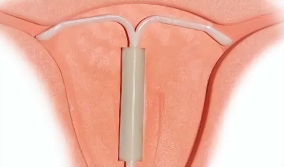 有流产历史再次怀孕生化,怀孕两次生化一次宫外孕