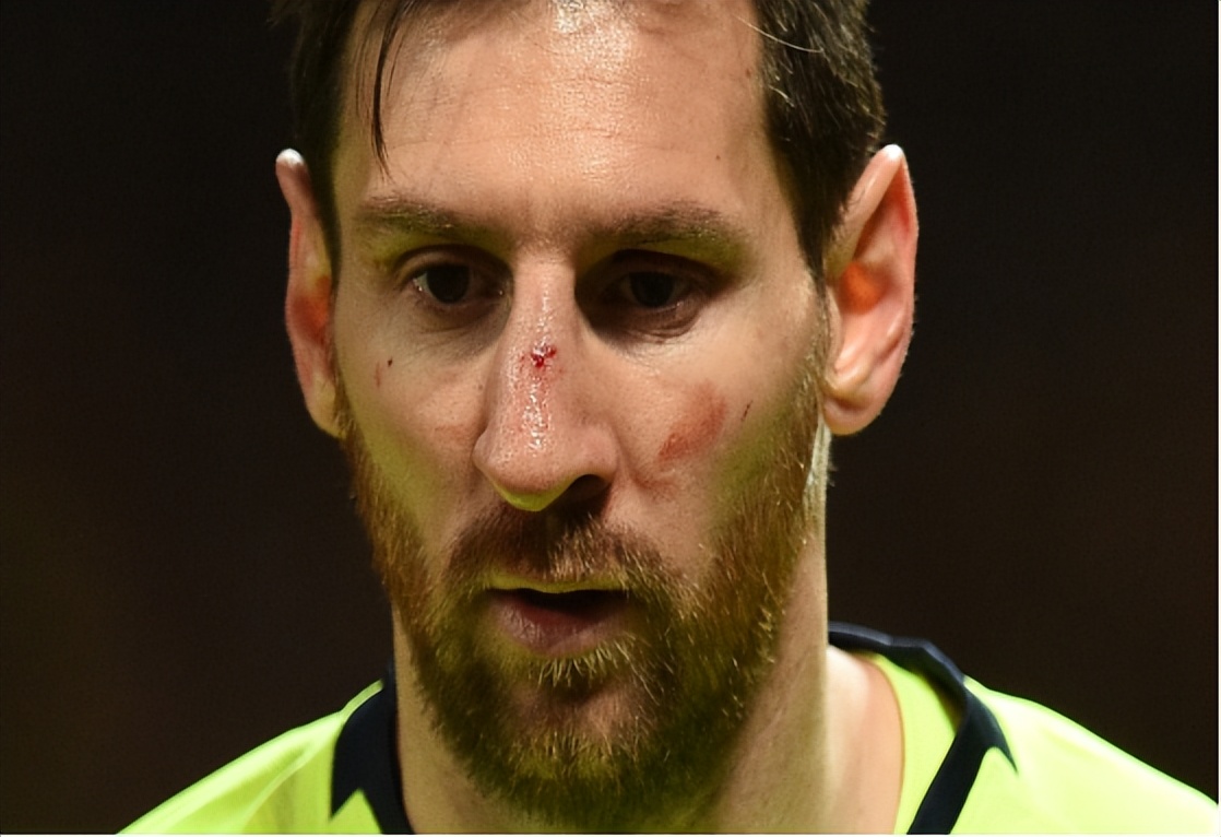 眼眶骨折怎么治疗,眼眶骨折算几级轻伤