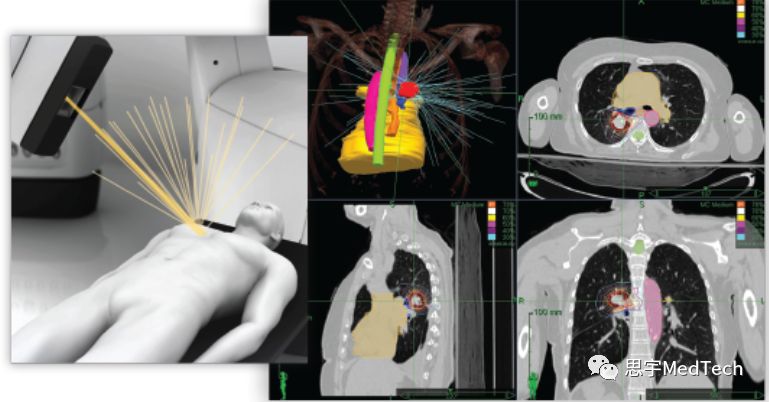 年入31亿！一文了解放疗小巨人安科锐