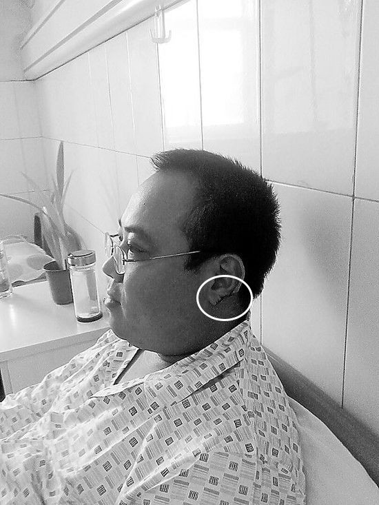 耳垂缺损|耳垂缺了一块还能复原吗？