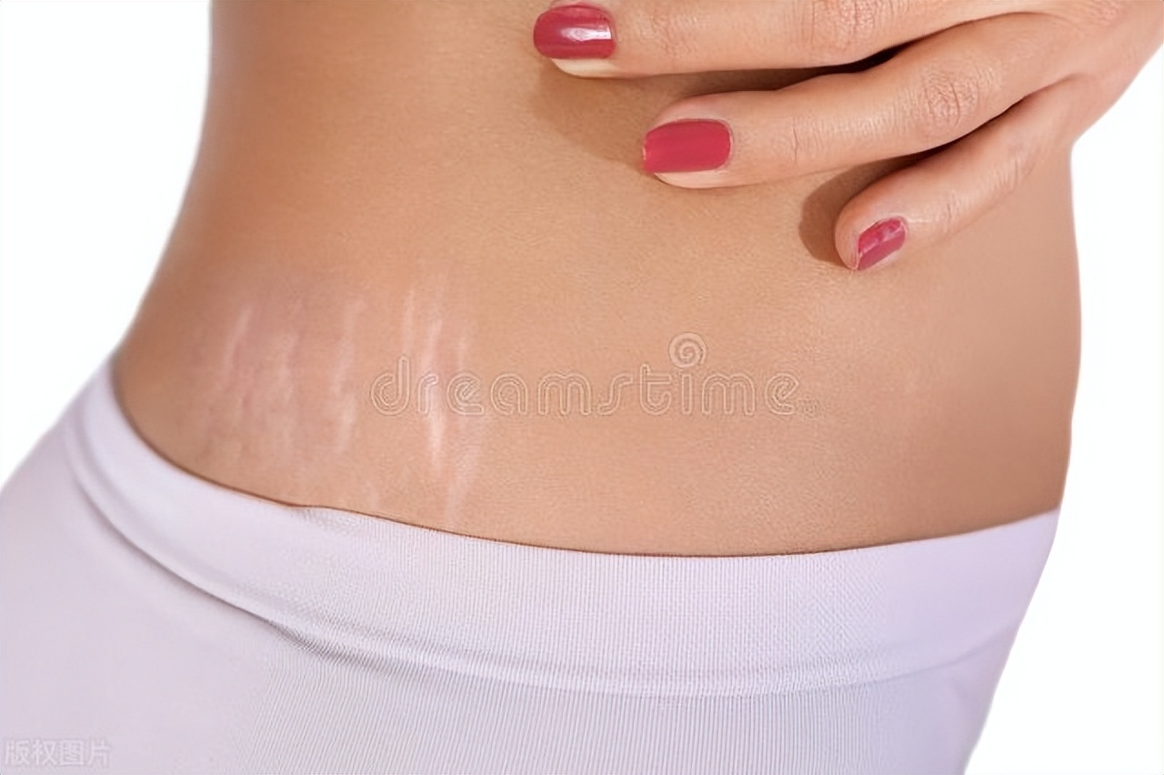 妊娠纹去除的药店小药膏,妊娠纹去除的好方法