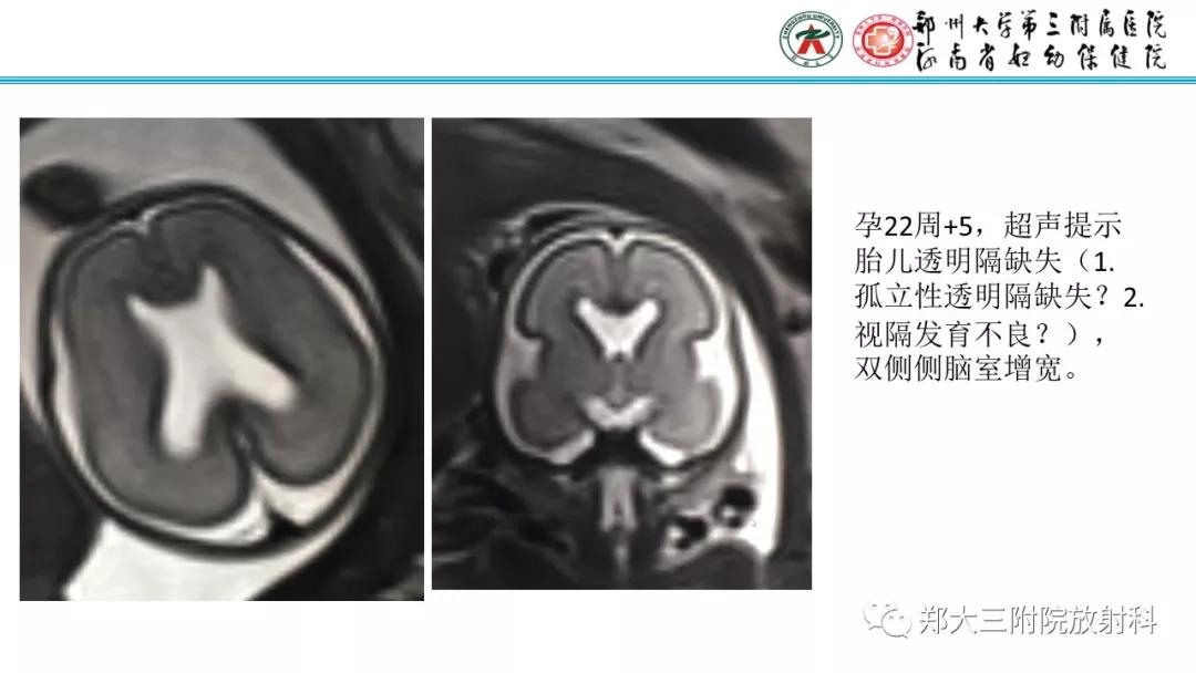 透明隔腔主要是判断什么,透明隔腔宽约10mm什么意思