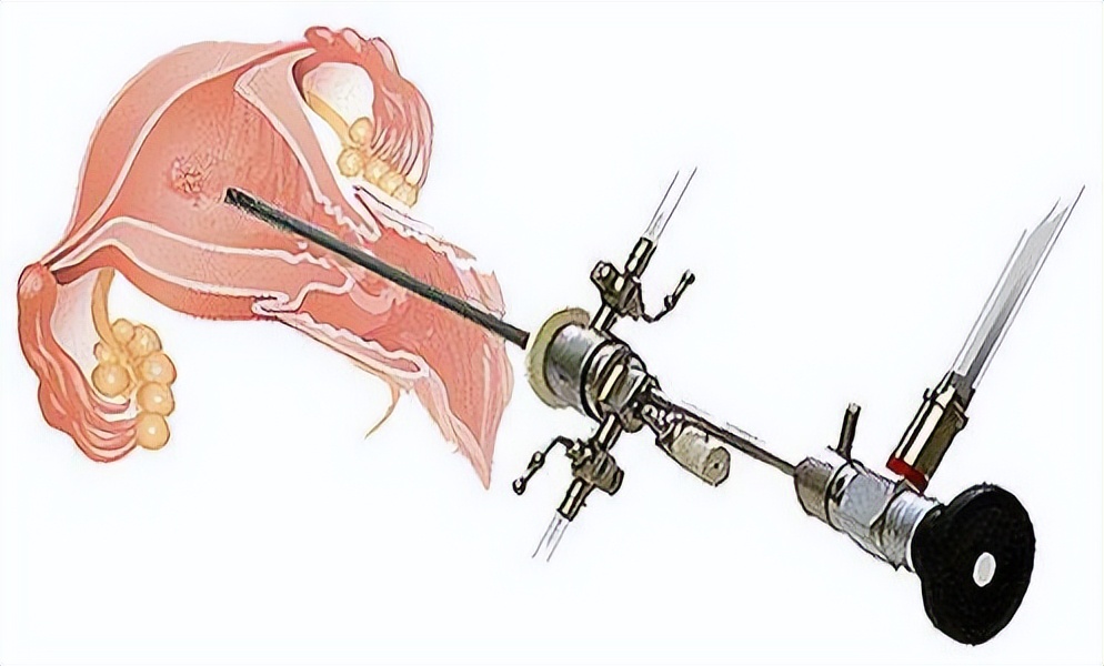 宫腔镜检查是什么意思,宫腔镜检查是什么