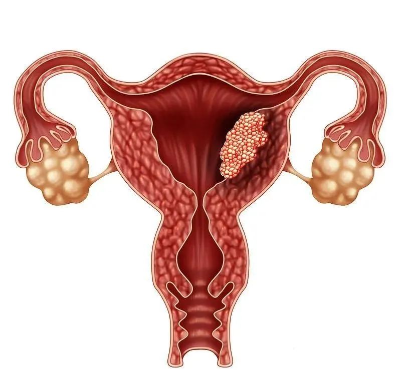 HPV感染相关的妇科疾病，抗HPV生物蛋白敷料带你了解