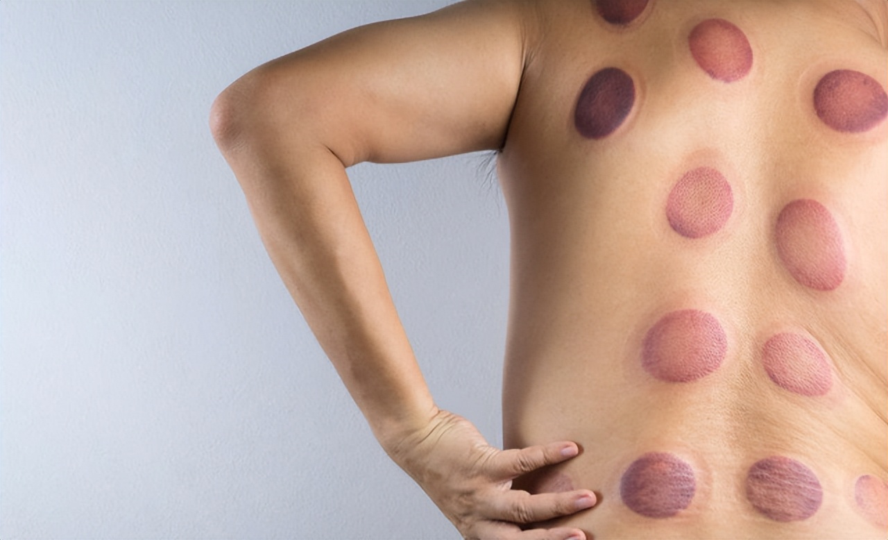 拔火罐吸出来的是湿气还是毒素,拔火罐吸出来的淤血是什么