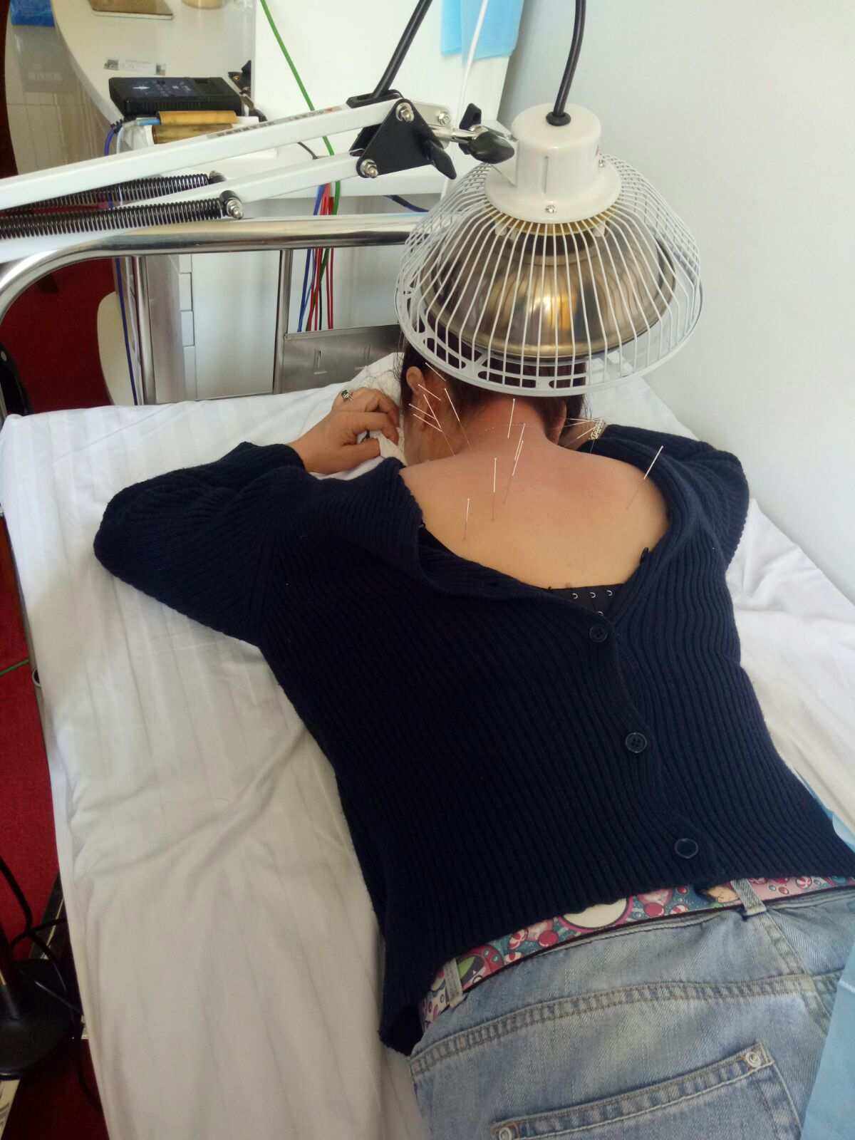 中医扎针治疗偏头痛,夹脊脉冲电针疗法