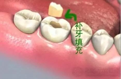 广州哪家医院看牙比较实惠,广州三甲医院种牙齿多少钱一颗