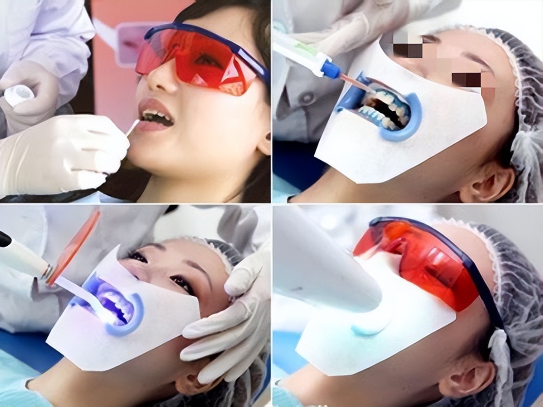 拯救泛黄皮肤磨皮美白,单颗牙临时美白