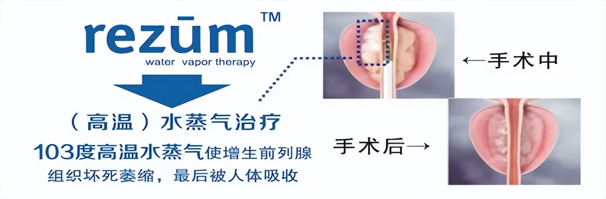 八旬成都大爷“下水道”堵了十多年！这项技术7分钟解决“男”言之隐