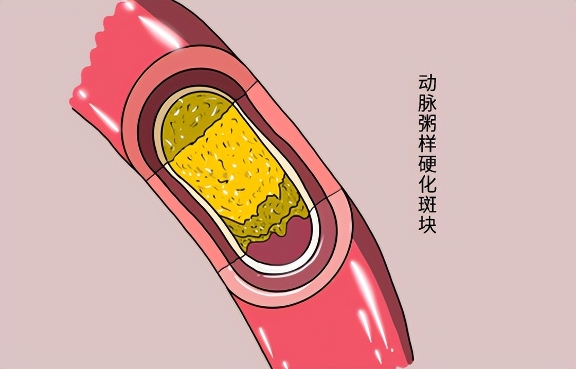 红酒泡洋葱能软化血管吗,红酒泡洋葱能否软化血管