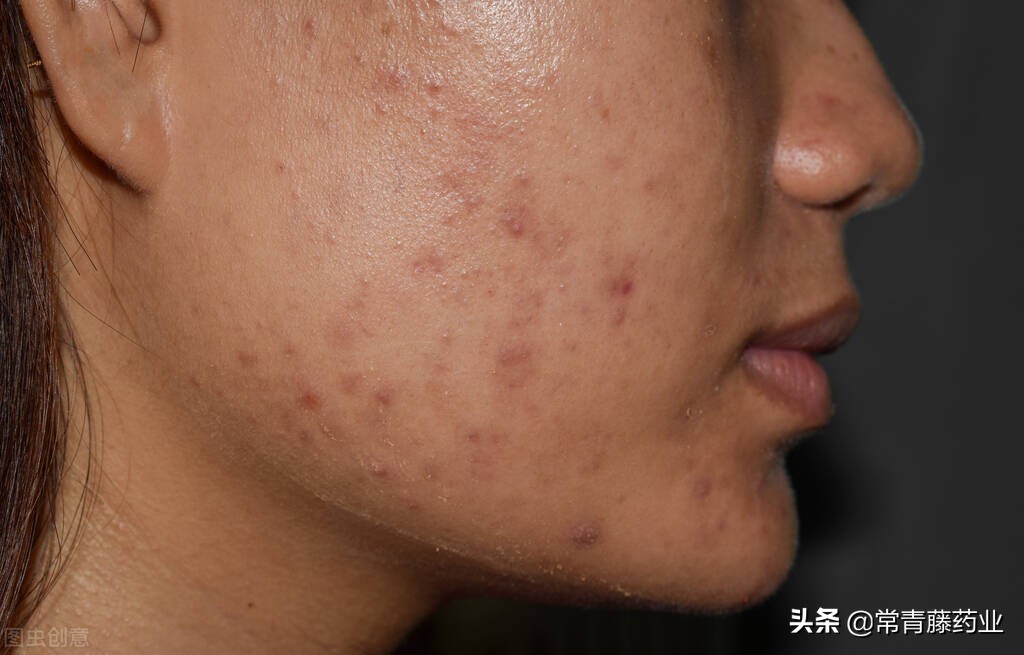 红痘印黑痘印如何快速解决,留下一大片黑红痘印怎么办