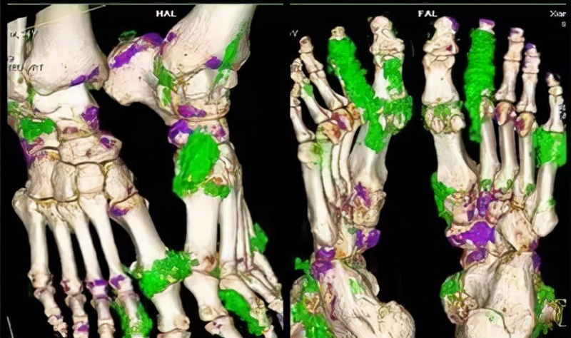 怎样才能确定是痛风性关节炎,关节疼如何区分是痛风还是风湿