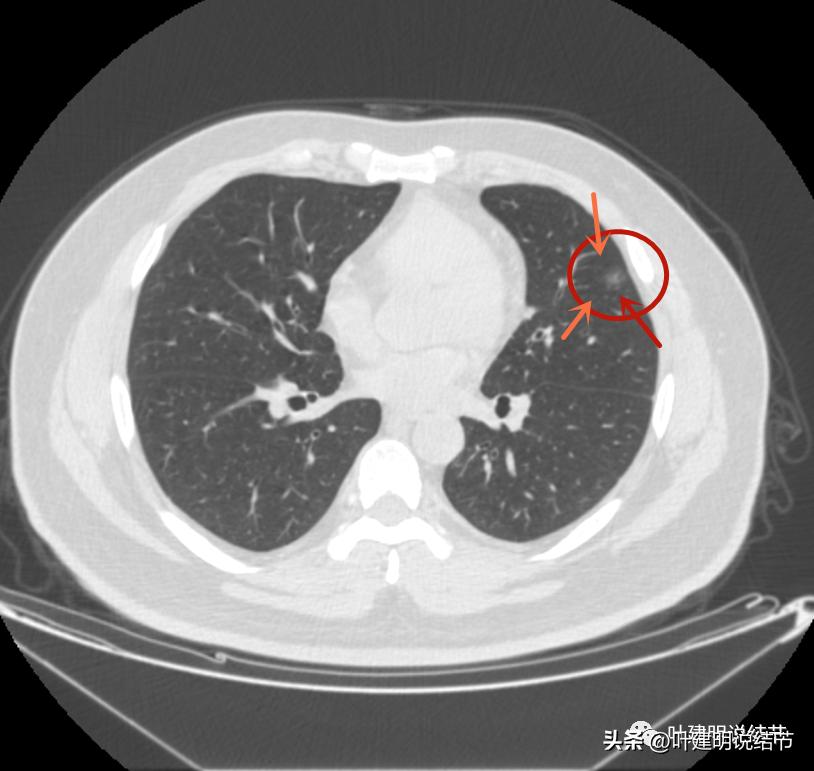 如何判断肺磨玻璃结节是高危结节,肺上有混合磨玻璃结节要注意什么