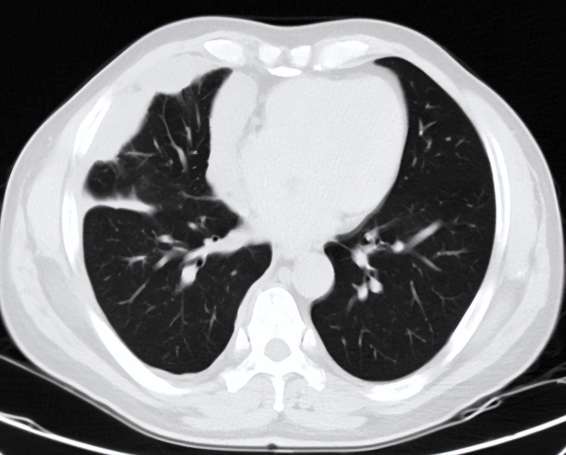 海南首例恶性胸膜间皮瘤,胸膜间皮瘤生存5年算治愈吗