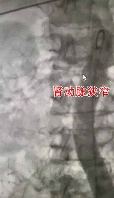 肾动脉狭窄患者介入治疗有危险吗,攻克高血压心脏病最新疗法