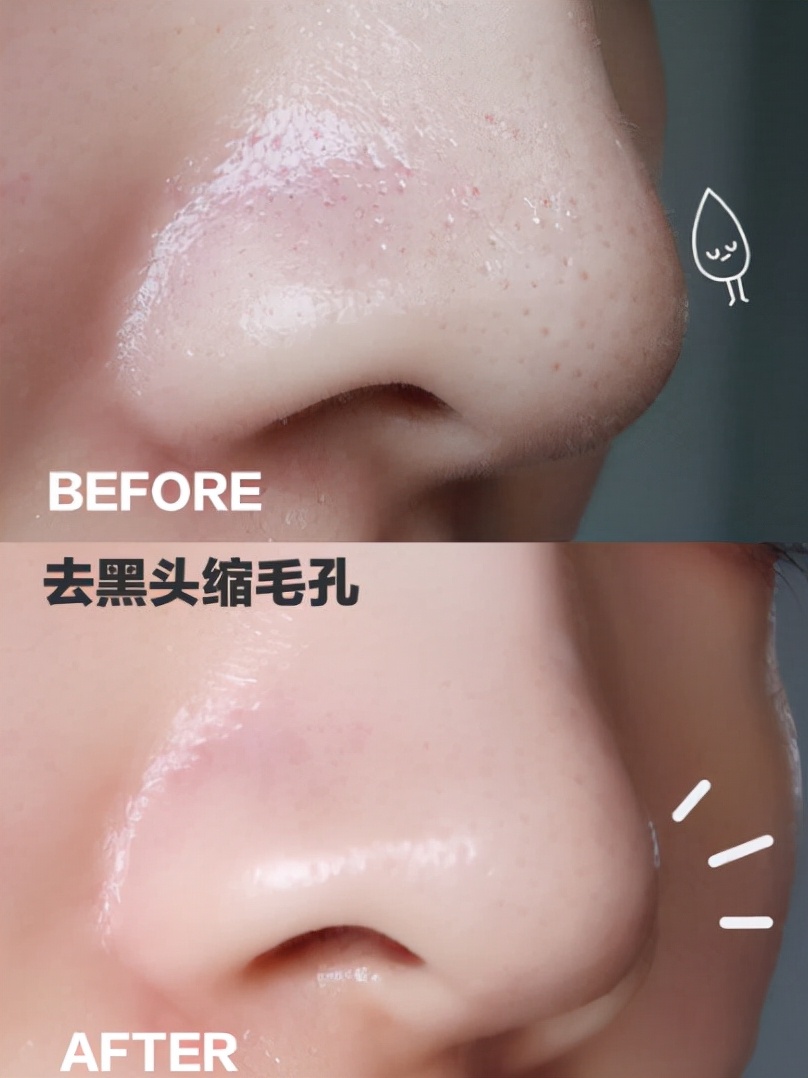 脸上有黑头怎么消除痘痘和黑头,脸上有黑头怎么消除最快方法